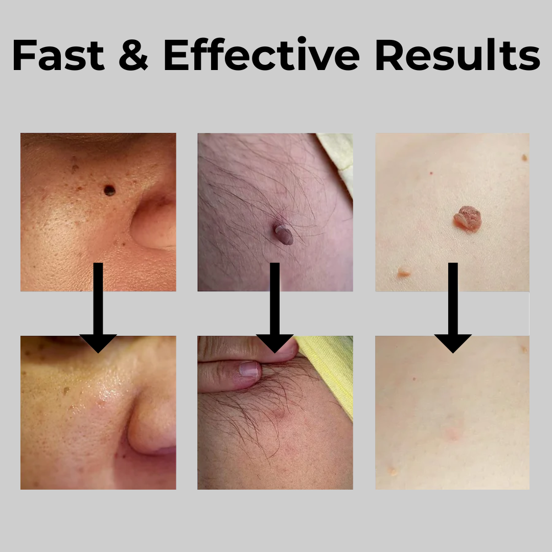 Auto Skin Tag Removal Kit