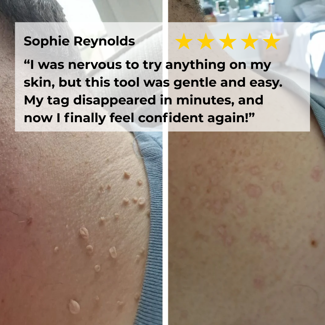 Auto Skin Tag Removal Kit