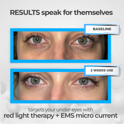 GlowEye™ EMS Therapy Device