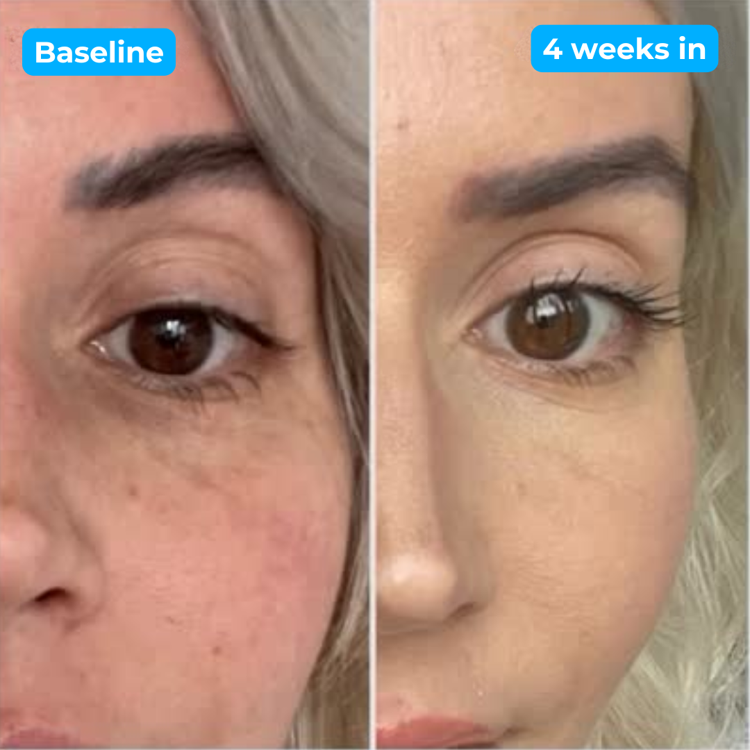 GlowEye™ EMS Therapy Device