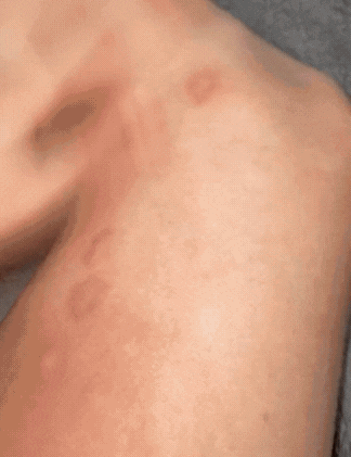 Instant Bite Relief Tool