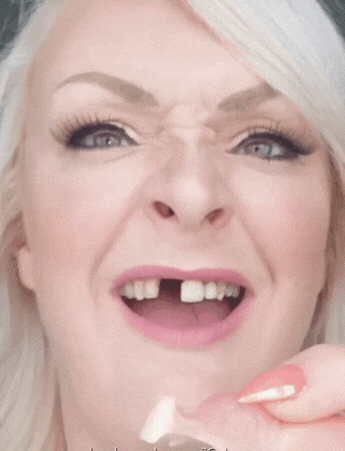 Instant Smile Magic Veneers