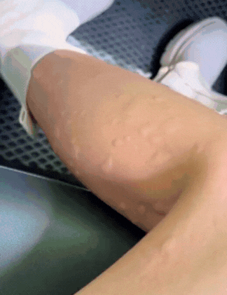 Instant Bite Relief Tool