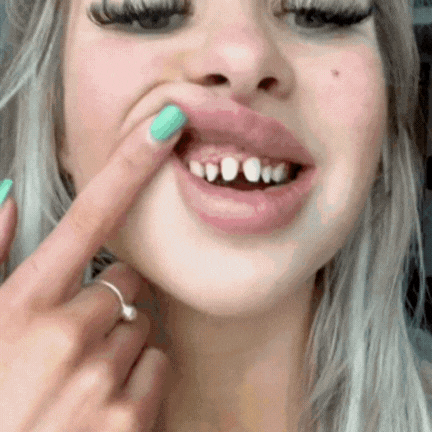 Instant Smile Magic Veneers